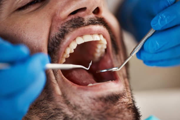 Best Emergency Wisdom Teeth Removal in Brookmont, MD