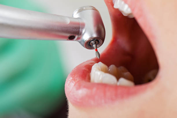 Best Emergency Dental Care for Broken or Chipped Teeth in Brookmont, MD